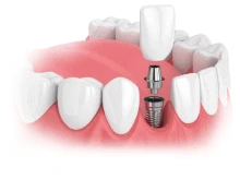 Single Tooth Dental Implant